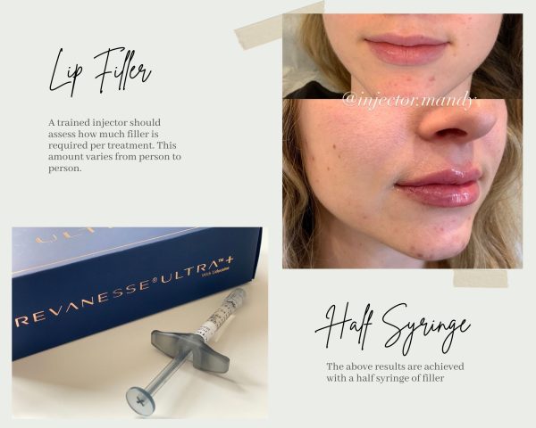 Lip Filler Lip Filler