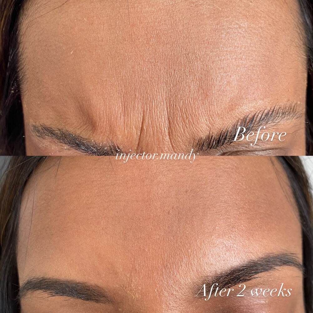 Botox Before and After