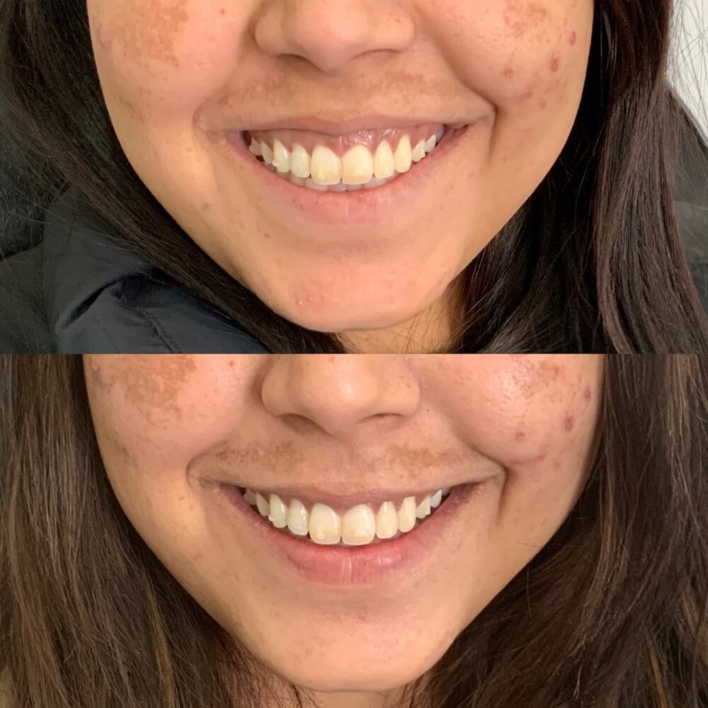 Botox Before and After