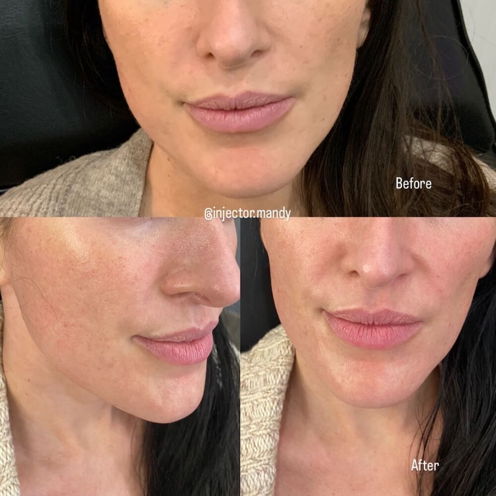 Botox Before and After