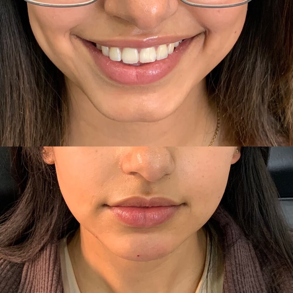 Chin Filler before and after
