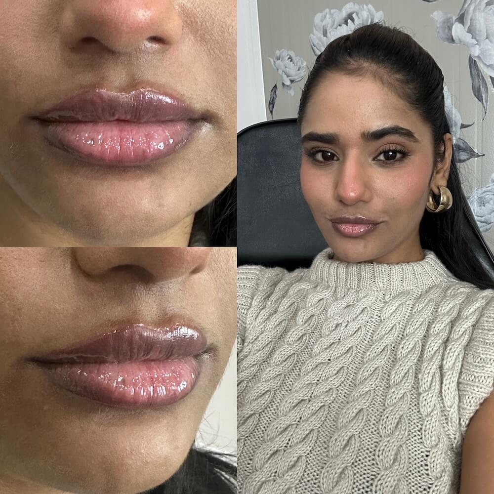 Lip filler