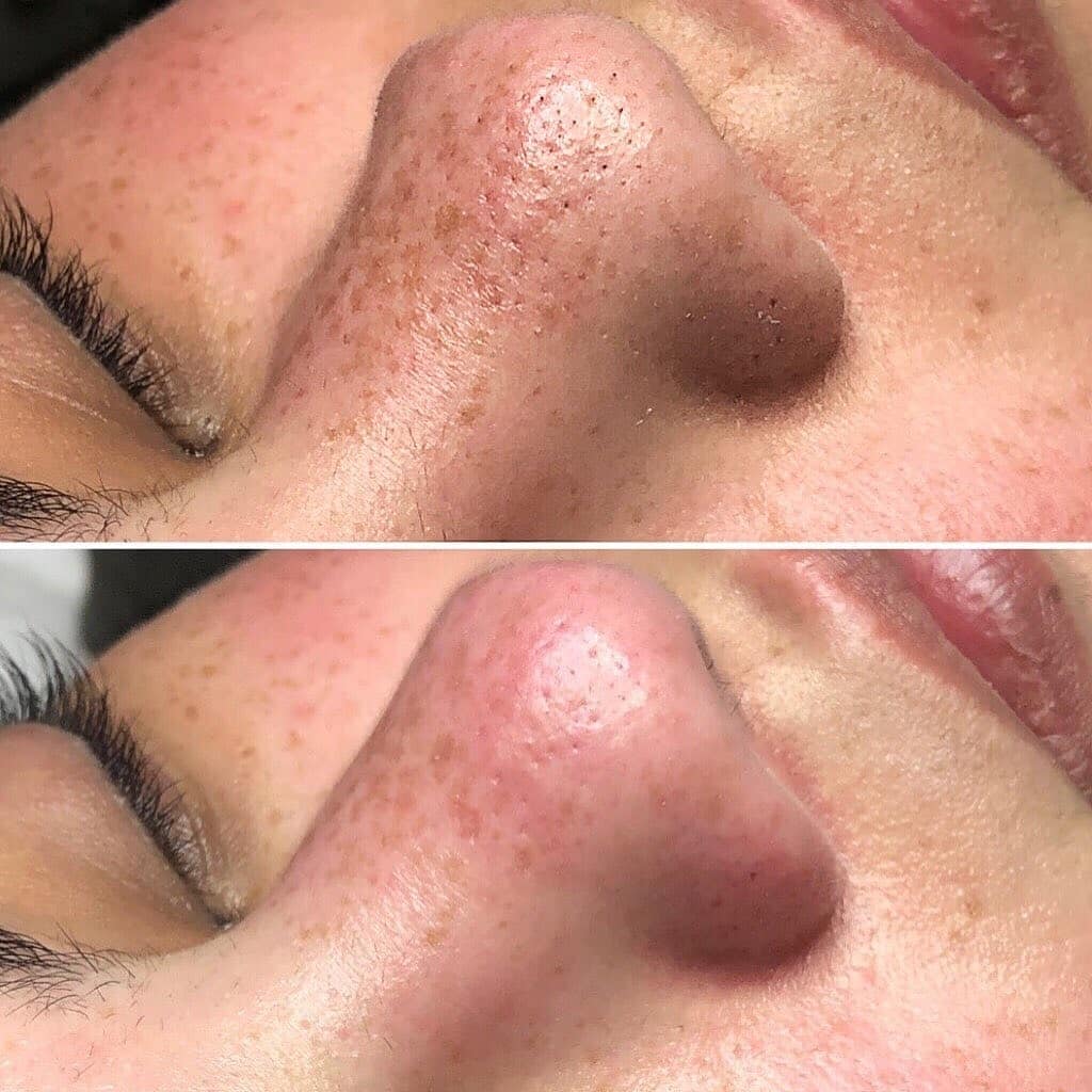 clean pores dermabrasion