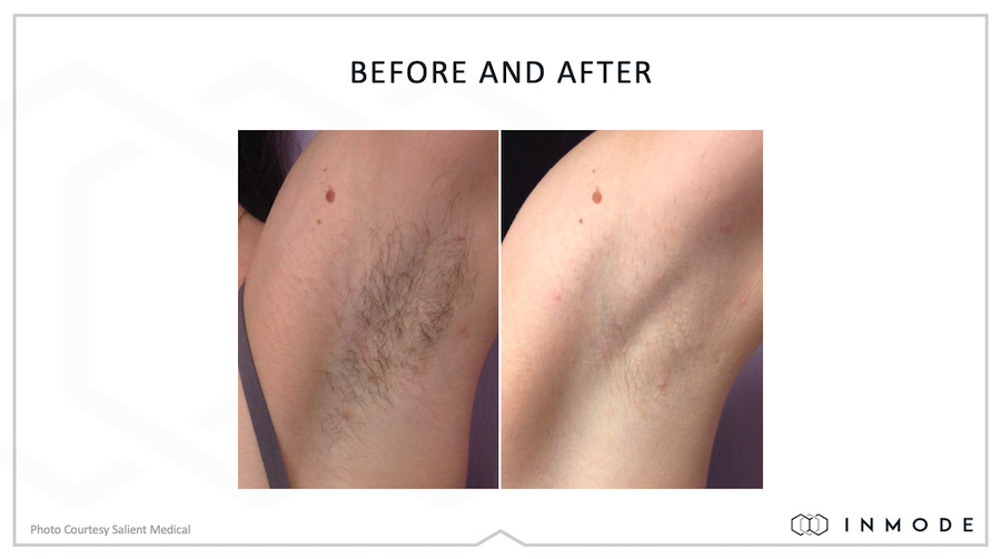 Diolaze Before and After Underarms