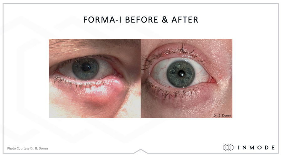 Forma I before and after